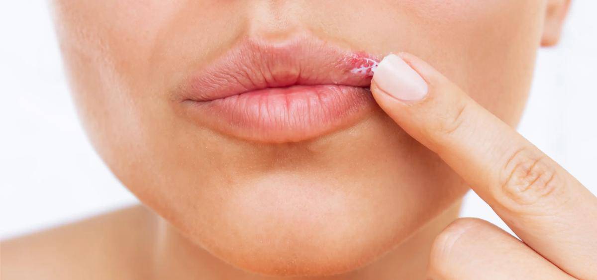 Leacuri Bătrânești pentru Herpes | Tratament Naturist