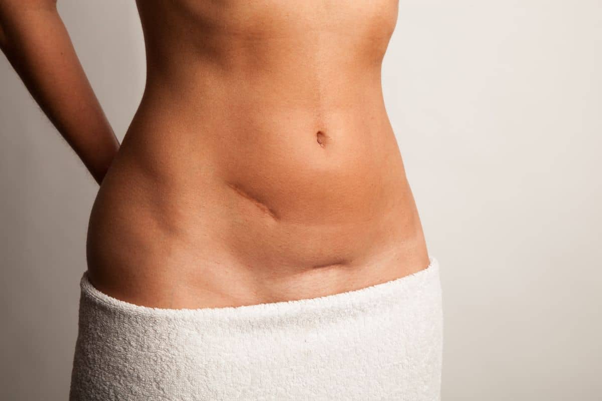 Tratament Naturist pentru Aderente Abdominale