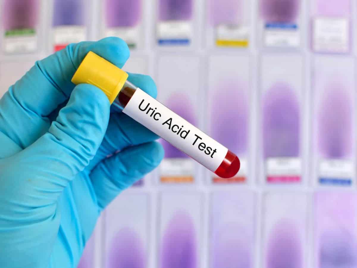 Eliminare Acid Uric Tratament Naturist