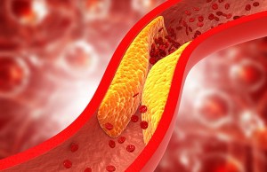 Cum-Scazi-Colesterolul-Rau-LDL-Leacuri-Batranesti