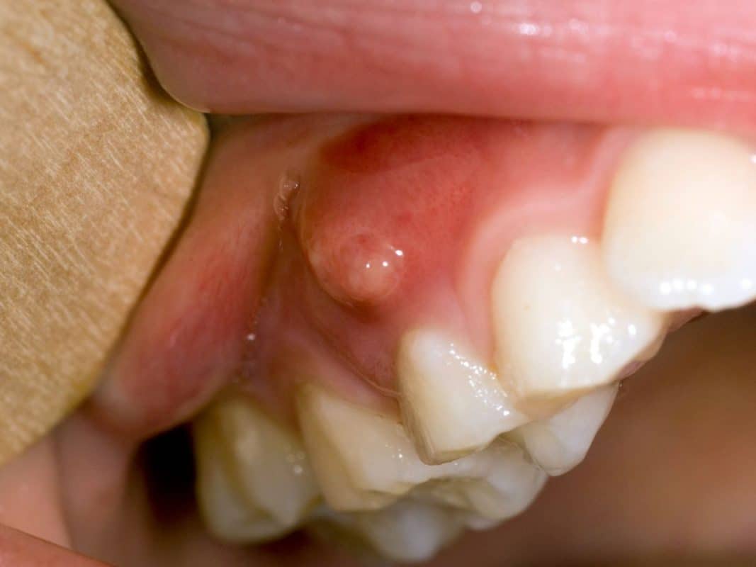 leacuri-abces-dentar