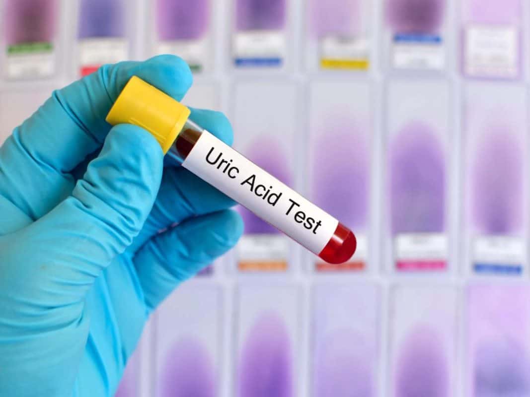 acid-uric-remedii