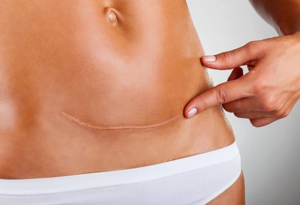 leacuri-pentru-aderente-abdominale